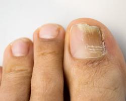 В чем причины и каково лечение утолщения ногтя на большом пальце ноги Почему ноготь на мизинце ноги толстый
